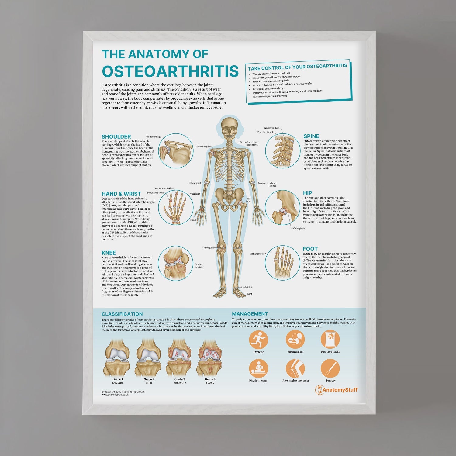The Anatomy of Osteoarthritis Chart / Poster - Part of Collection