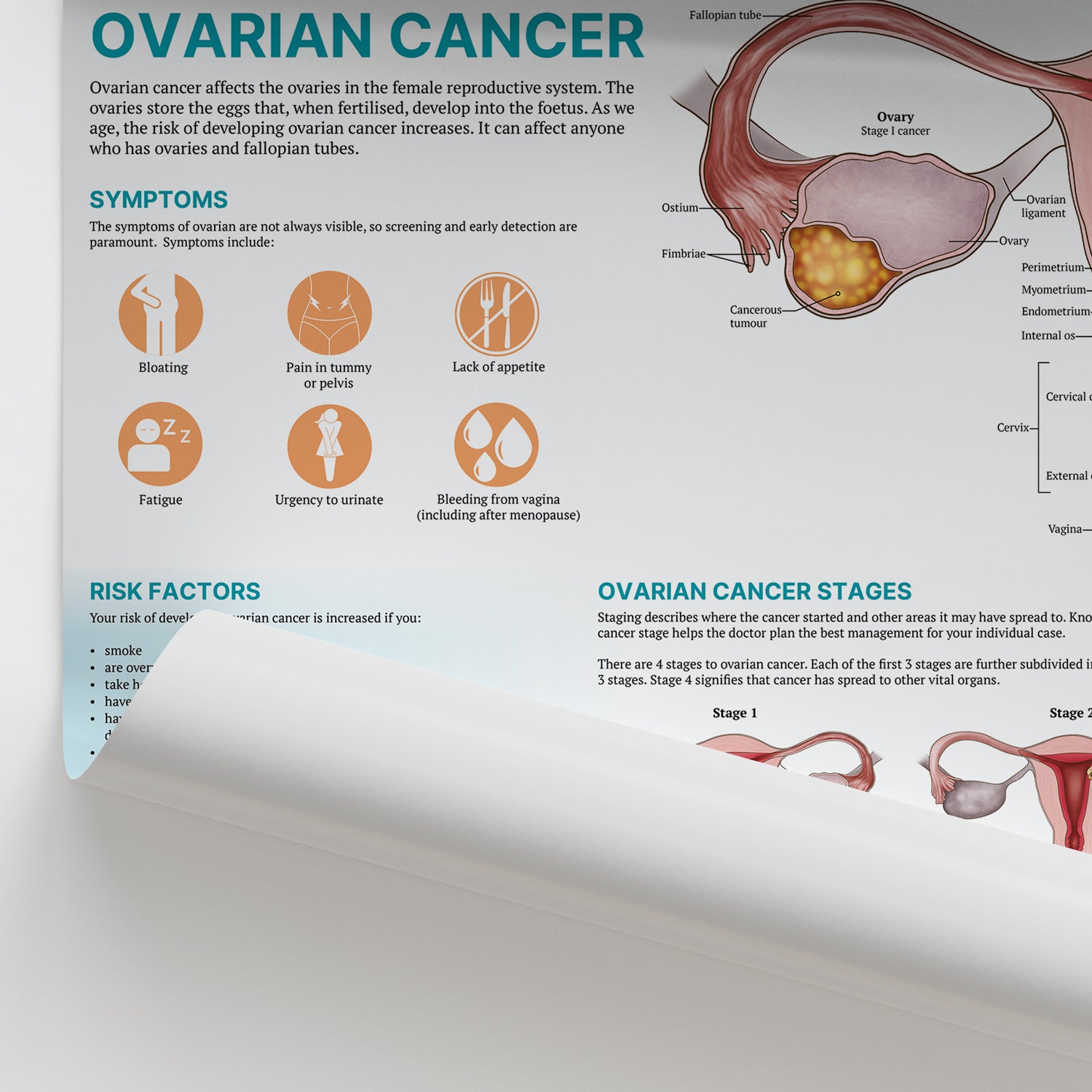 The Anatomy of Ovarian Cancer Chart / Poster