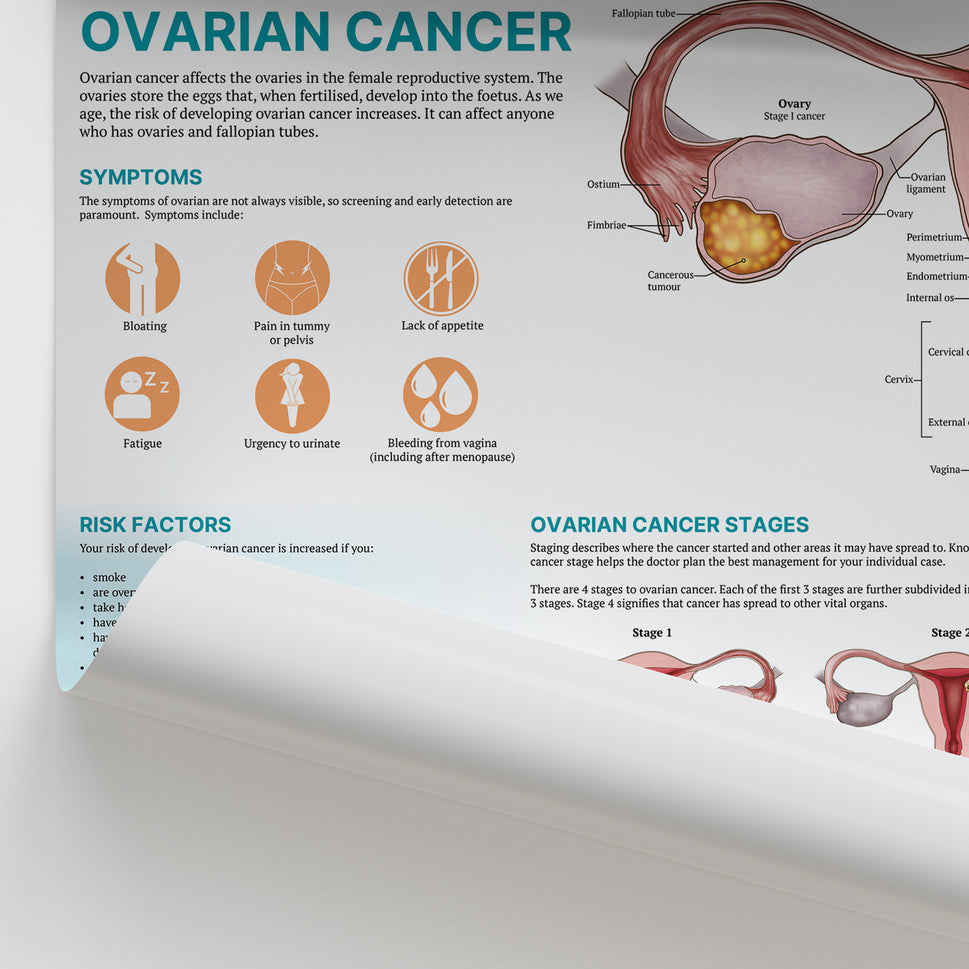 The Anatomy of Ovarian Cancer Chart / Poster