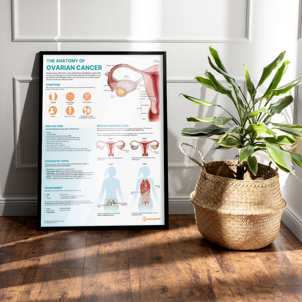 The Anatomy of Ovarian Cancer Chart / Poster