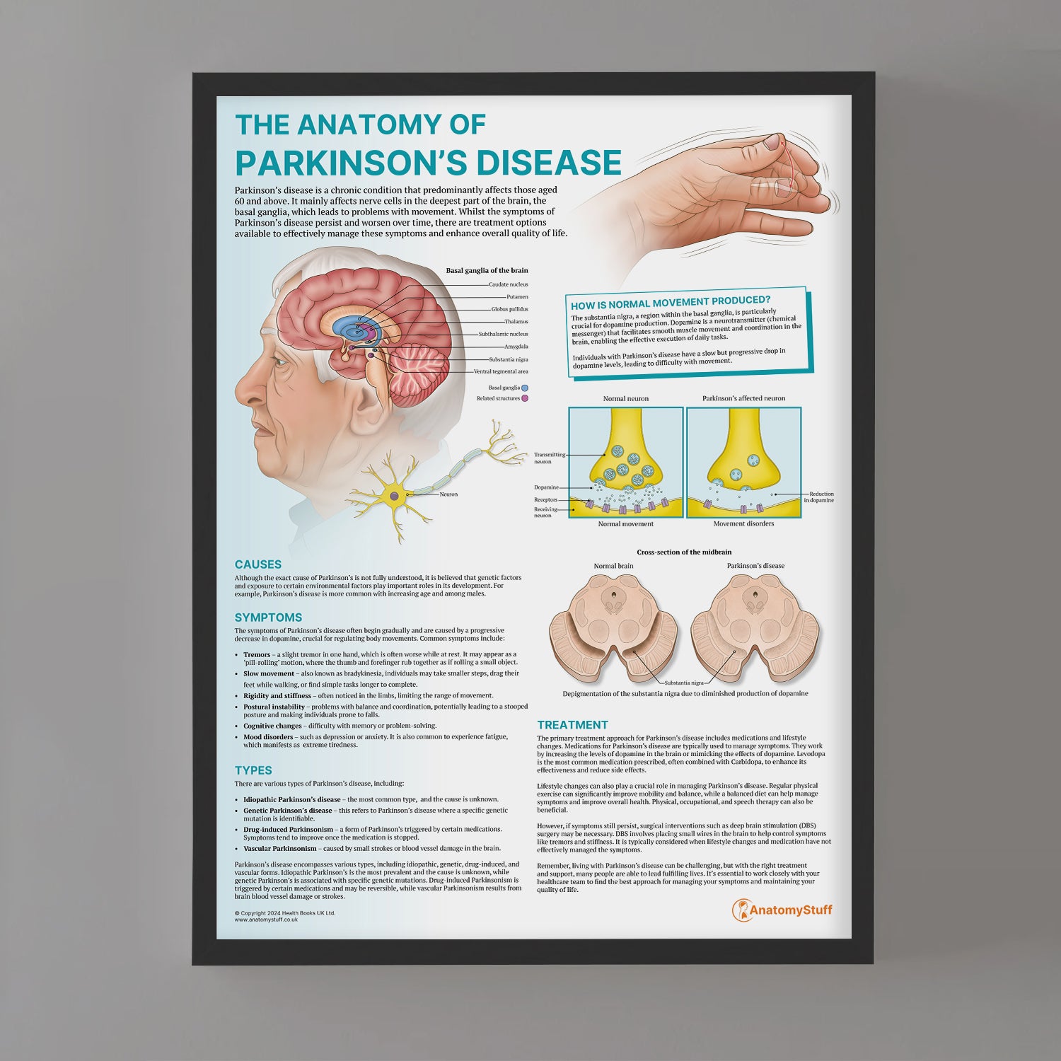 The Anatomy of Parkinson's Disease Chart / Poster