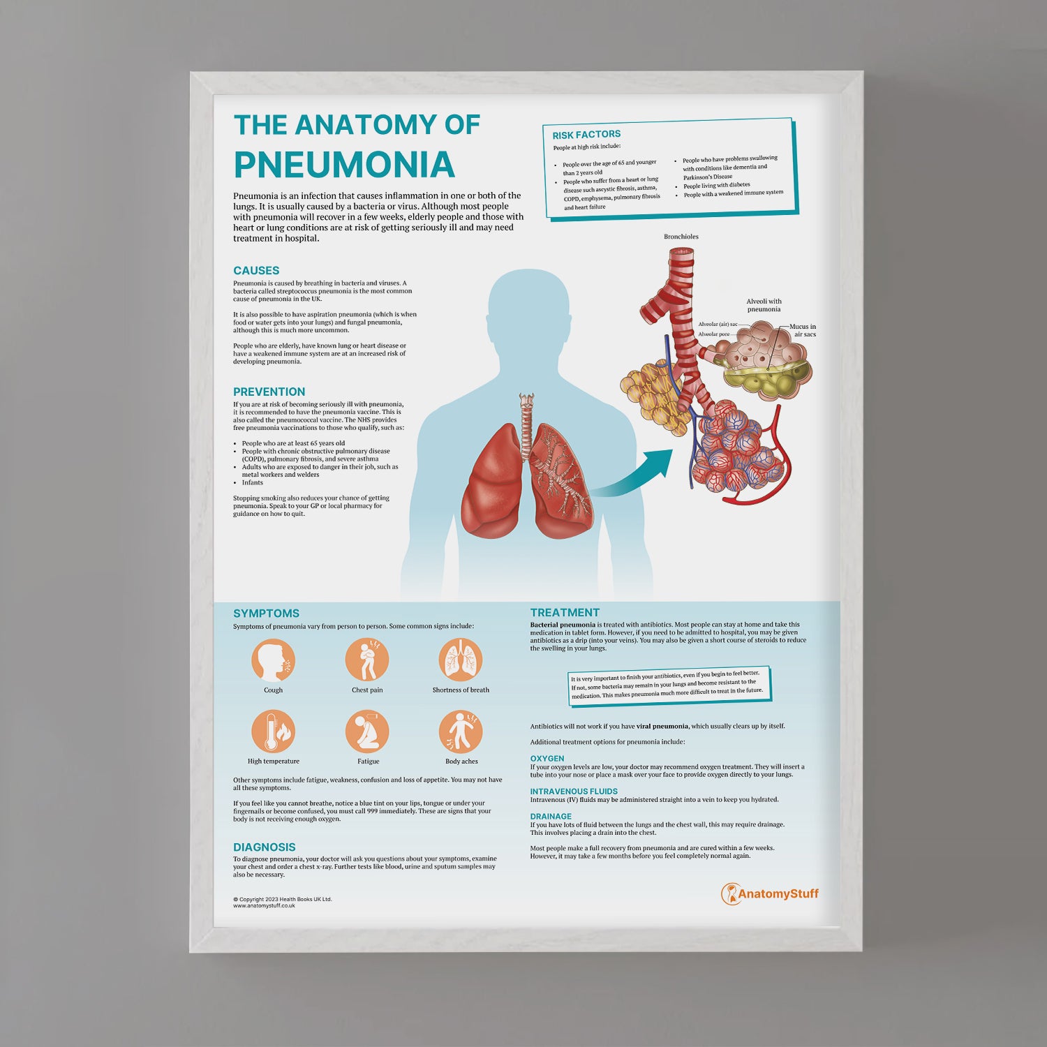 The Anatomy of Pneumonia  Chart / Poster