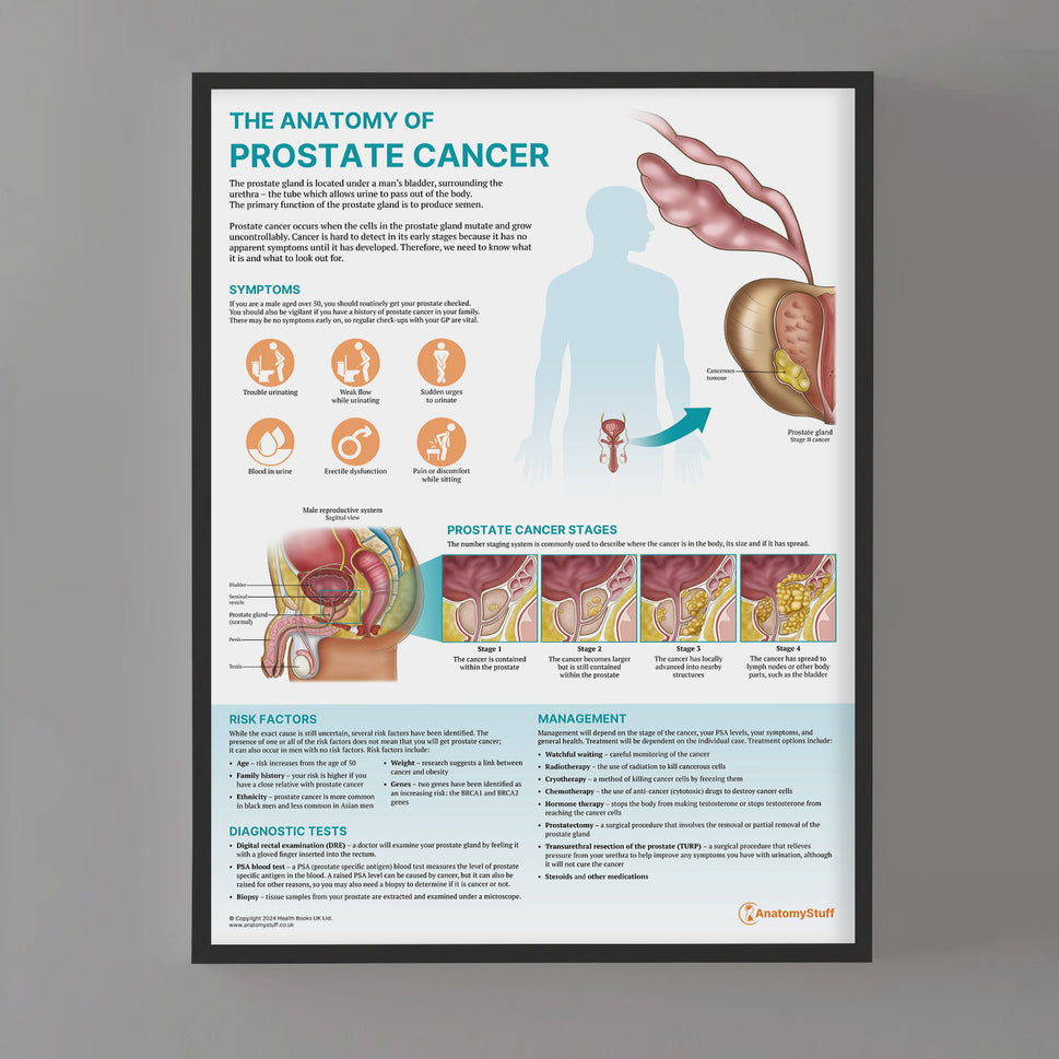 The Anatomy of Prostate Cancer Chart / Poster