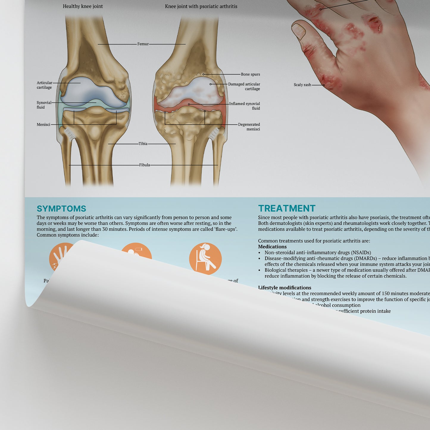 The Anatomy of Psoriatic Arthritis Chart / Poster