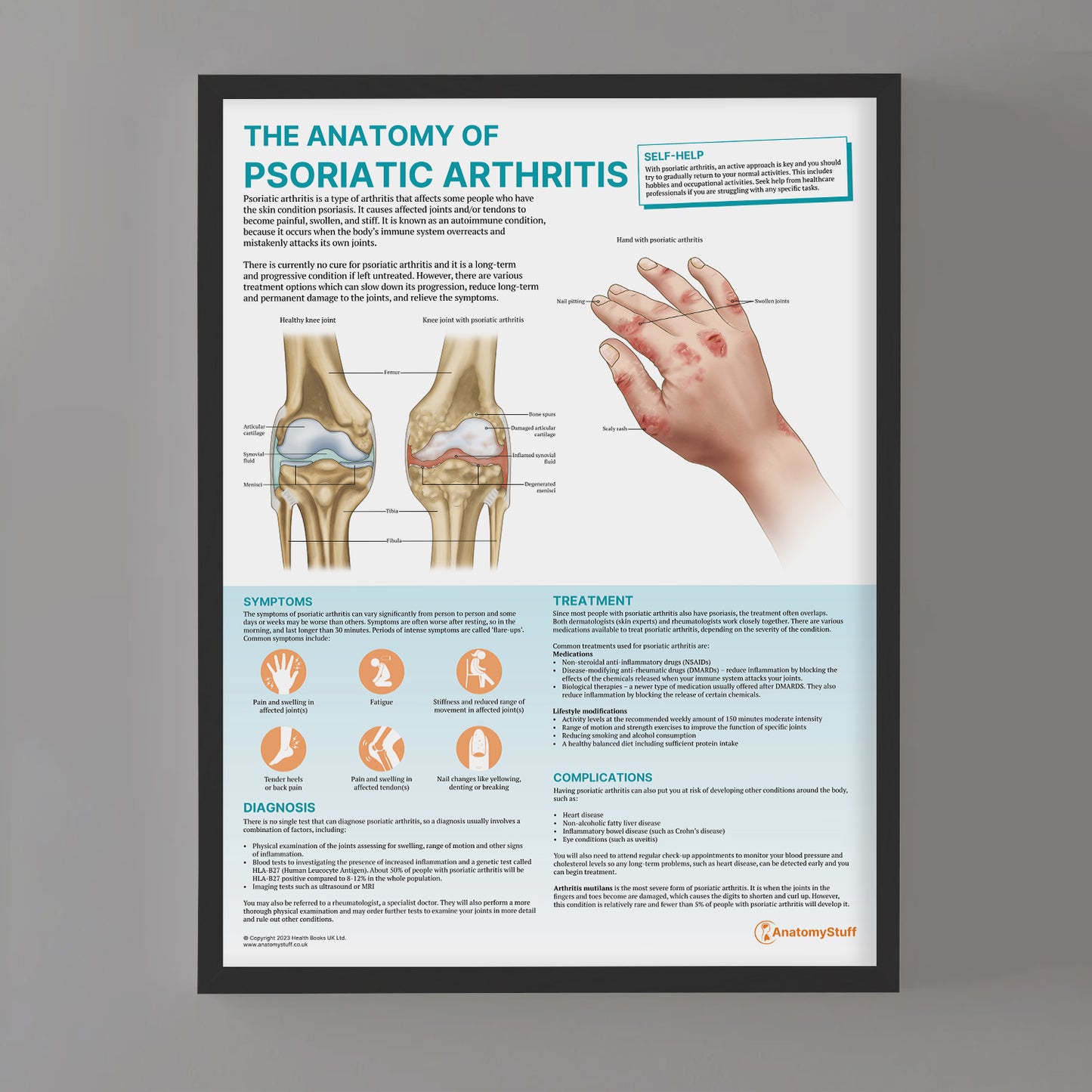 The Anatomy of Psoriatic Arthritis Chart / Poster