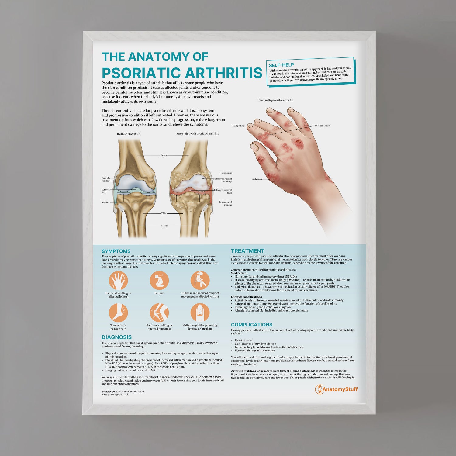 The Anatomy of Psoriatic Arthritis Chart / Poster