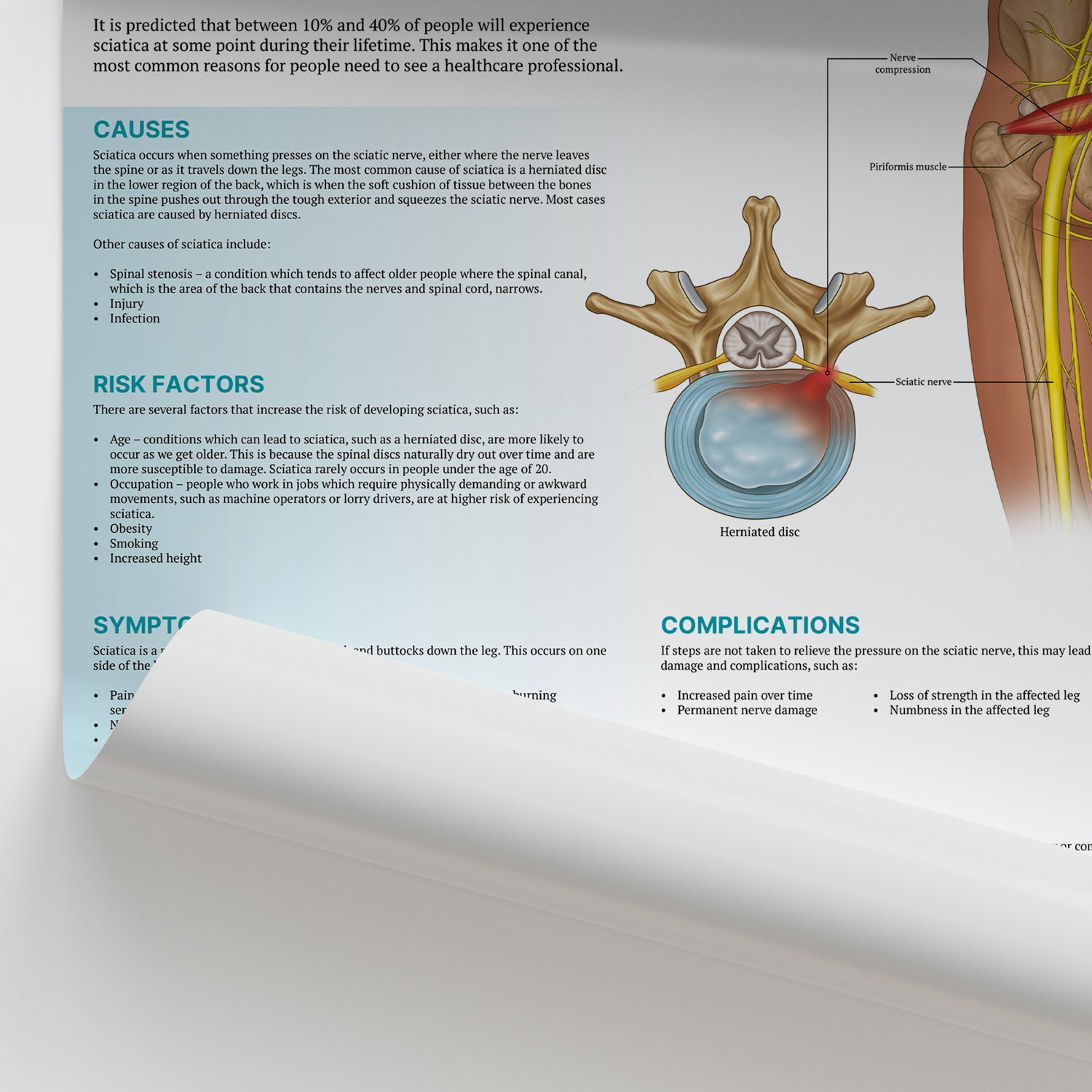 The Anatomy of Sciatica Chart / Poster