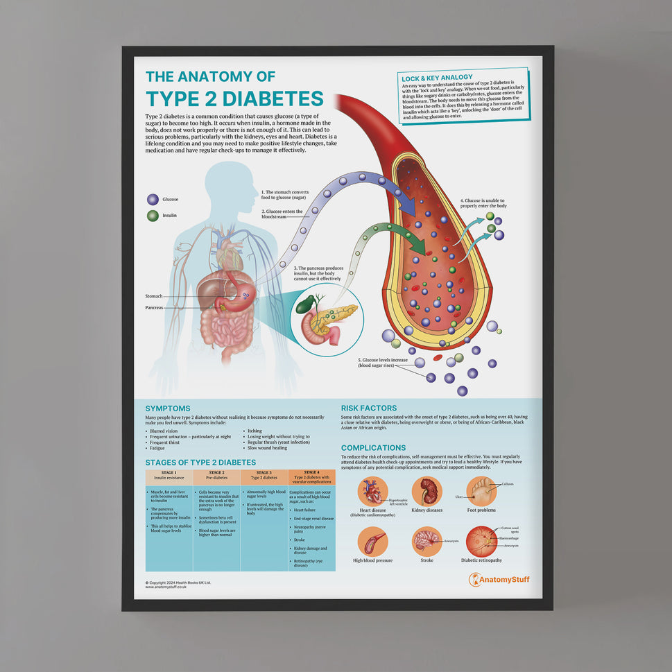 The Anatomy of Type 2 Diabetes Chart / Poster