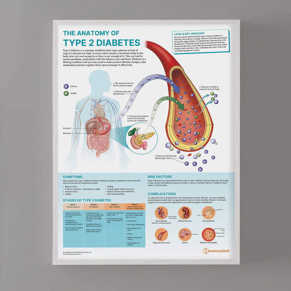 The Anatomy of Type 2 Diabetes Chart / Poster