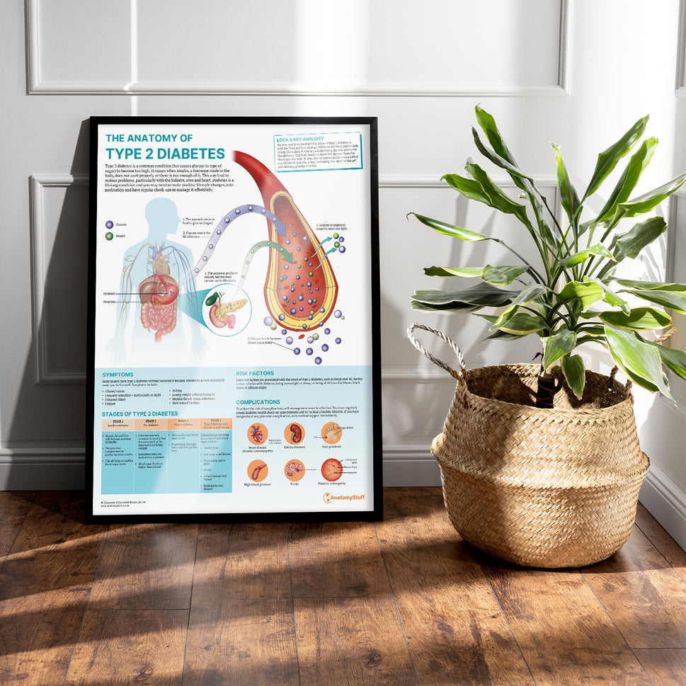 The Anatomy of Type 2 Diabetes Chart / Poster