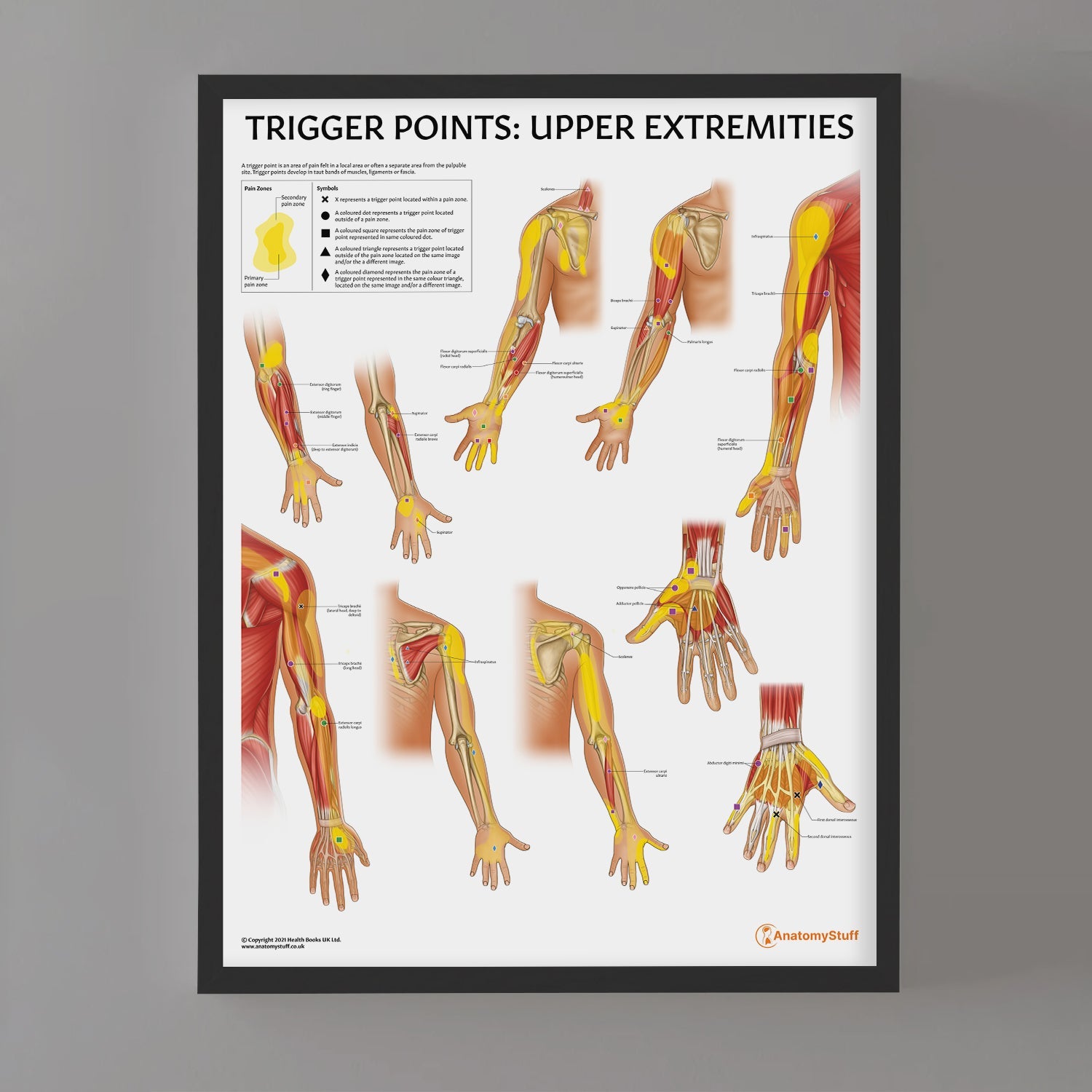 Trigger Points: Upper Extremities Chart / Poster - Part of Collection