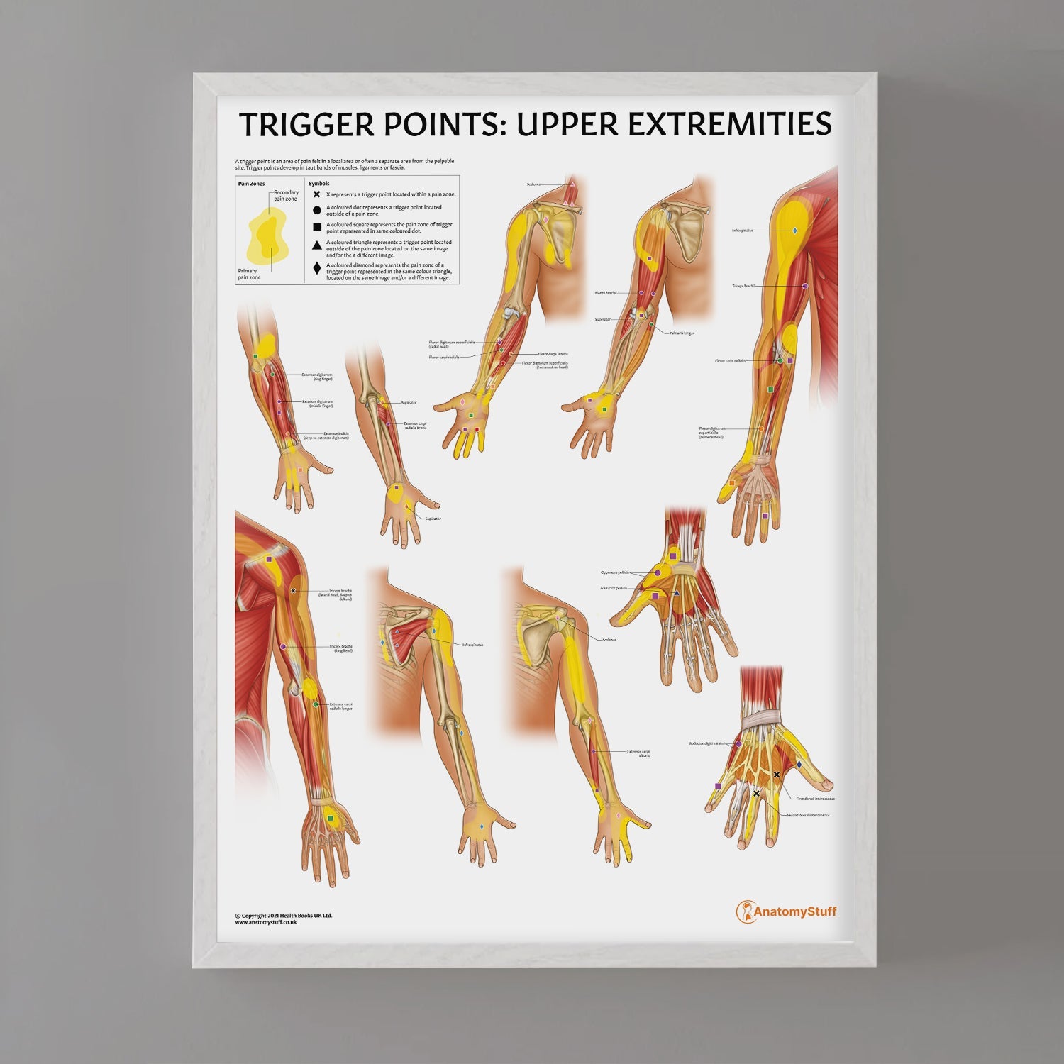Trigger Points: Upper Extremities Chart / Poster - Part of Collection