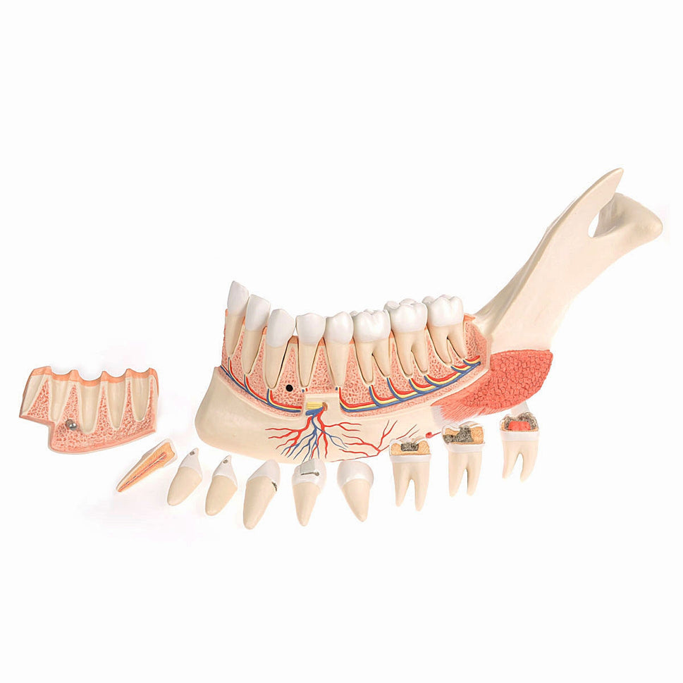 Half Lower Jaw Model with 8 Diseased Teeth (19 part)