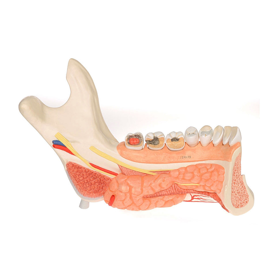 Half Lower Jaw Model with 8 Diseased Teeth (19 part)