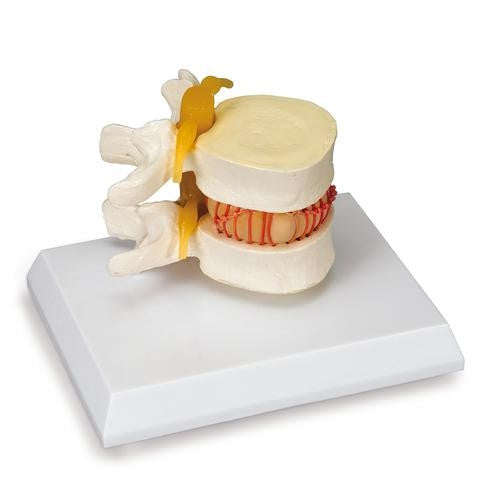 Prolapsed Disc Spinal Simulator