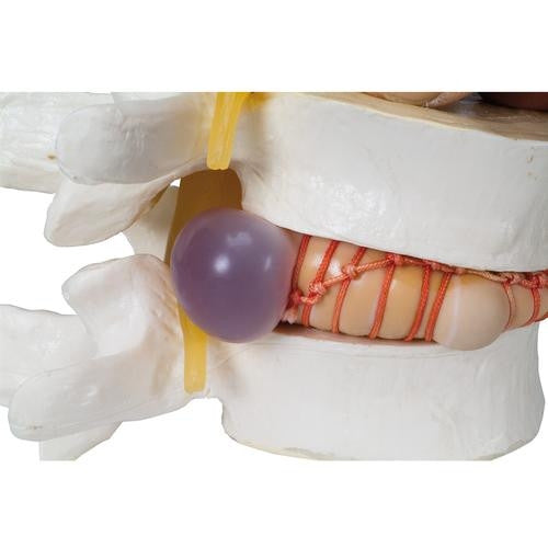 Prolapsed Disc Spinal Simulator
