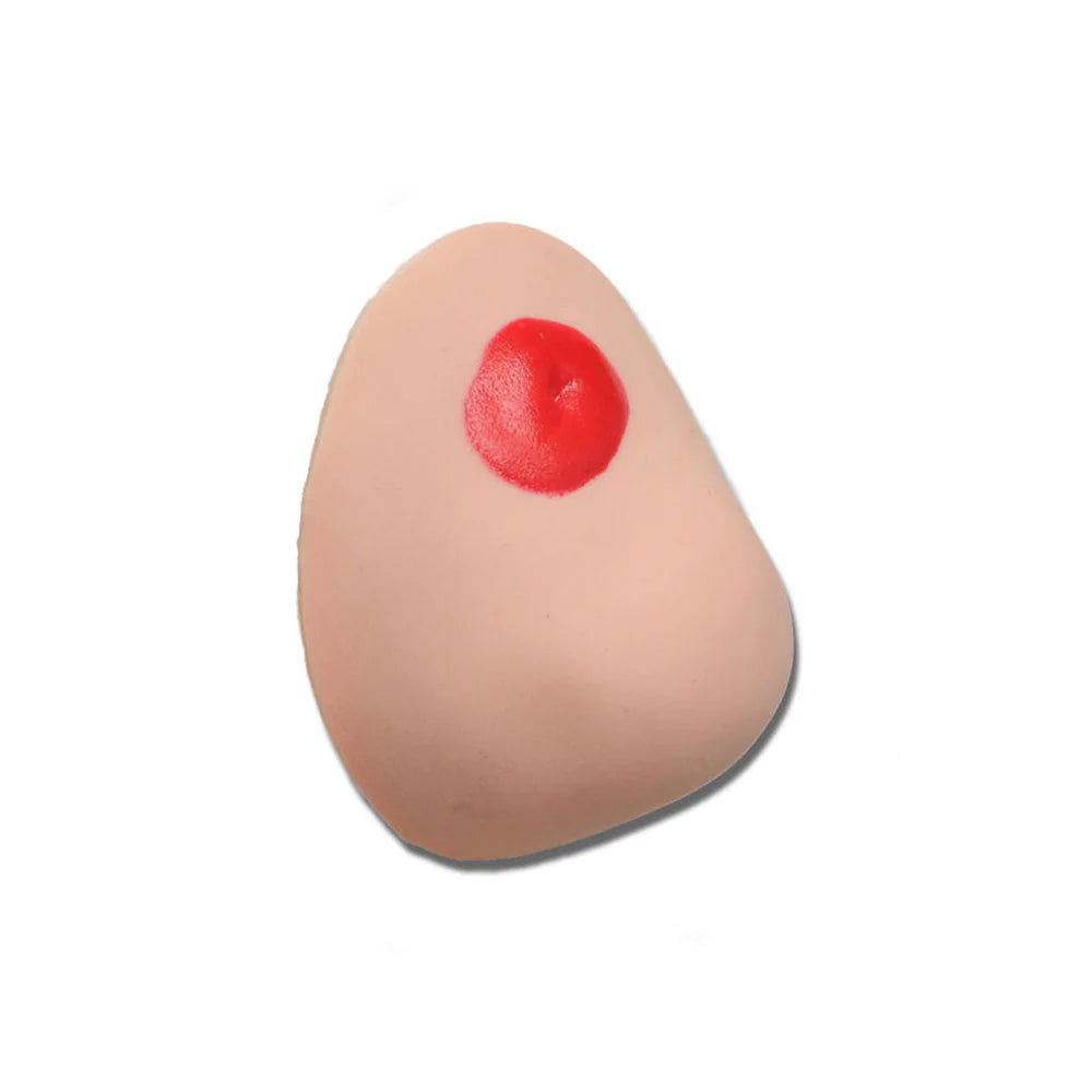 Parastomal Hernia Stoma For Otto Ostomy