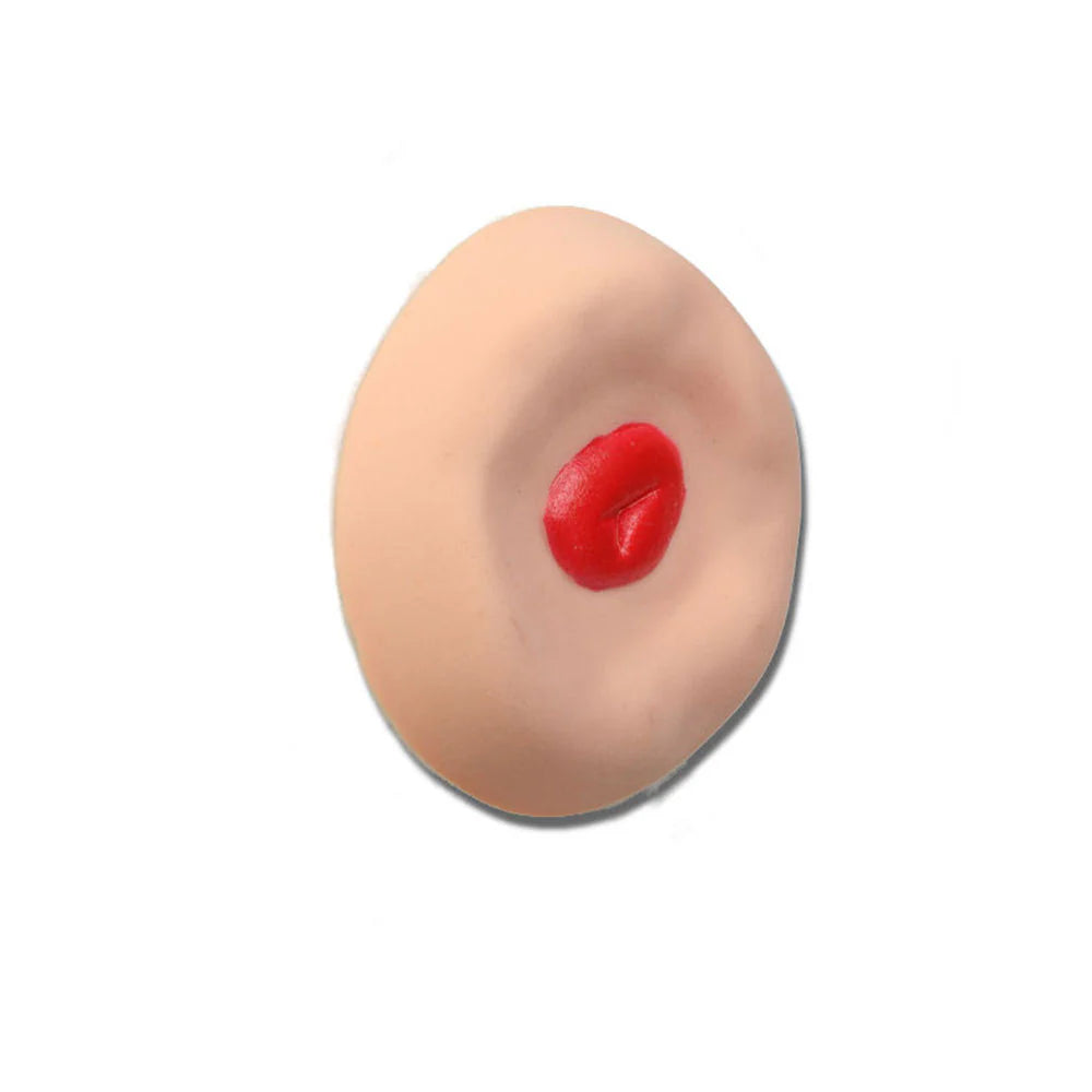 Recessed Stoma For Otto Ostomy