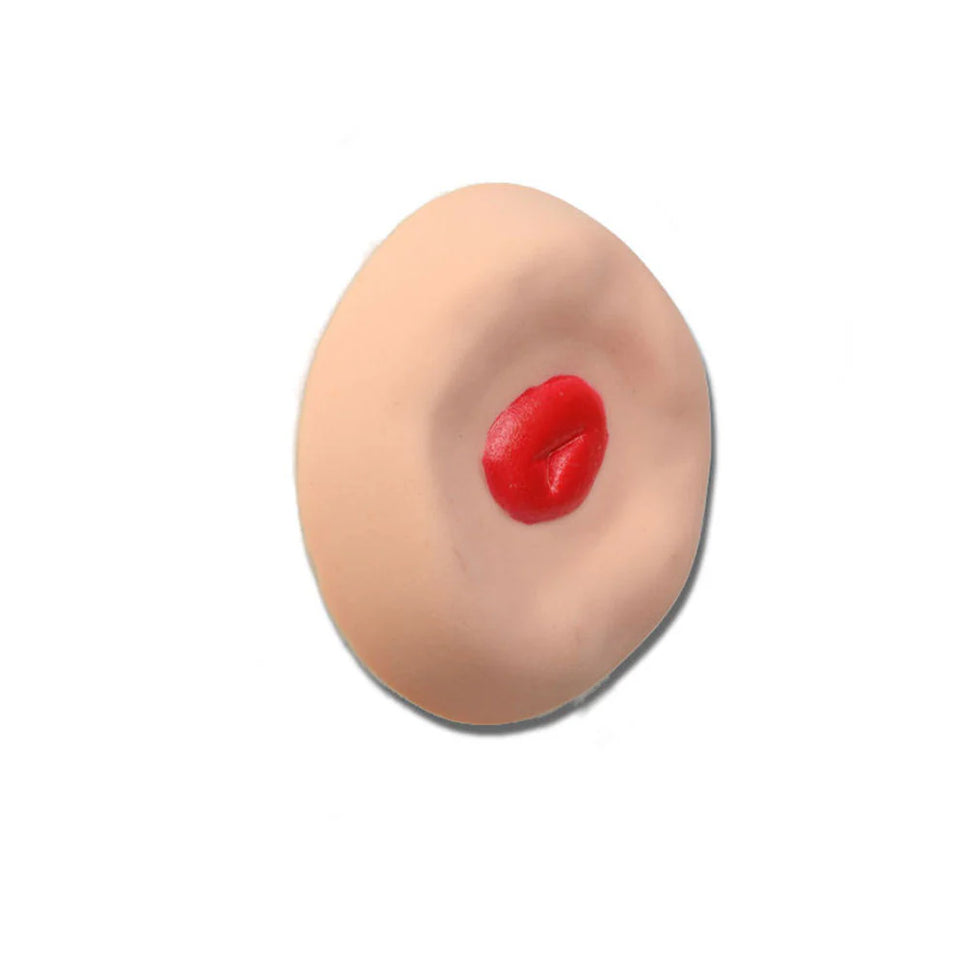 Recessed Stoma For Otto Ostomy