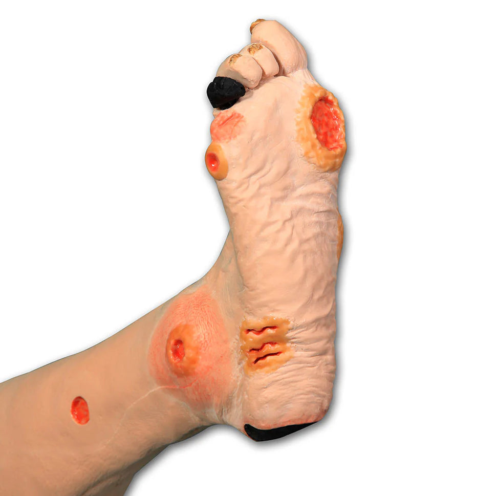 Annie Arterial Insufficiency Leg