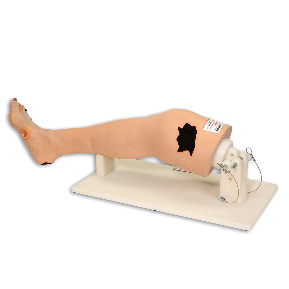 Annie Arterial Insufficiency Leg