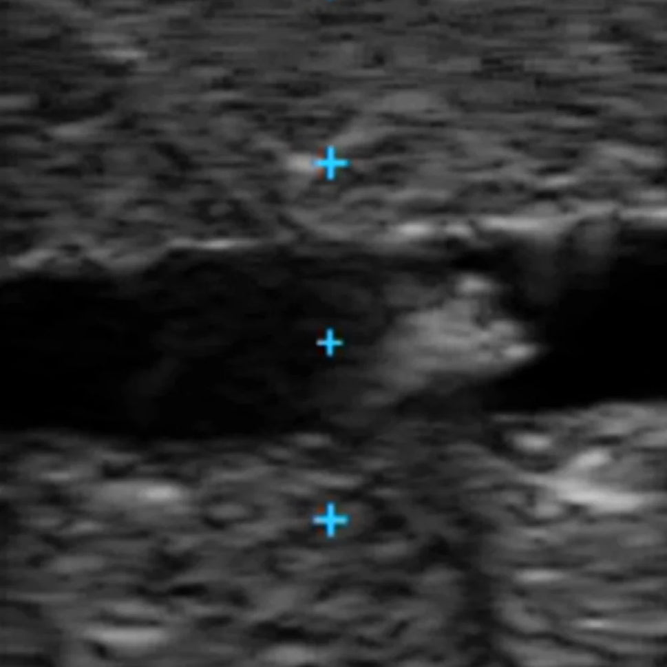 Vascular Access Ultrasound Phantom (4 Vein Bifurcated)