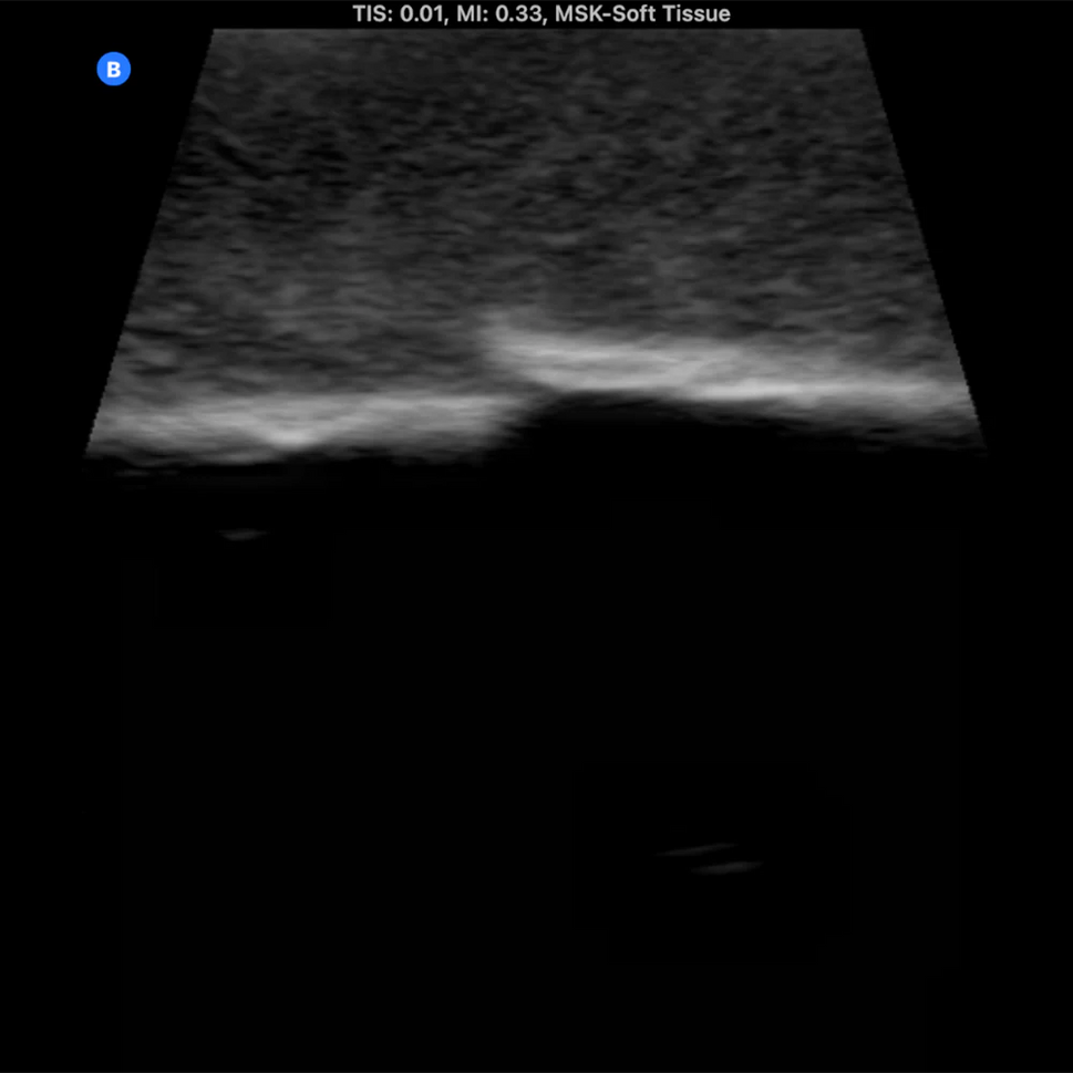 Ultrasound Phantom Bone Fracture