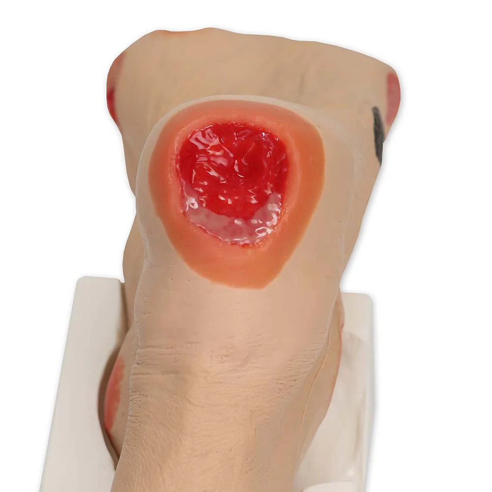 Wilma Wound Foot Trainer