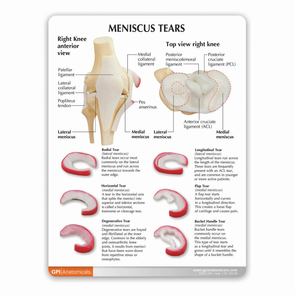 Knee Meniscus Tears Model