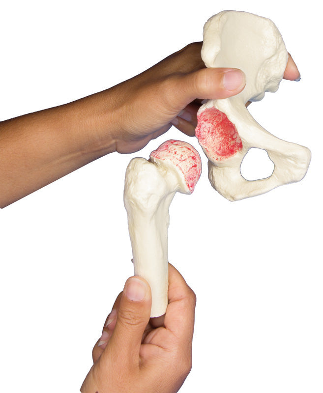 Hip Implant / Replacement Model Set (3 part)