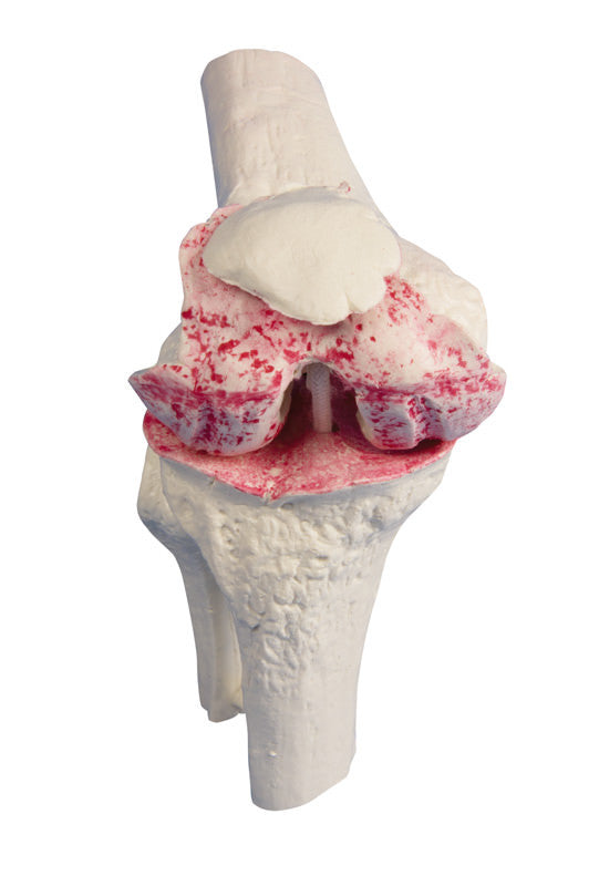 Knee Implant / Replacement Model Set (3 part)