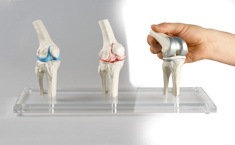 Knee Implant / Replacement Model Set (3 part)