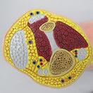 Switch Model shows displaced tendons, bone erosion, inflammation and swelling of the tissue 3 image
