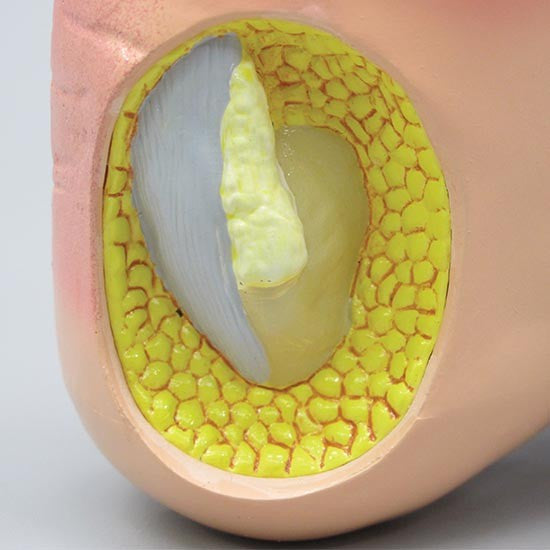 Gout Foot Model
