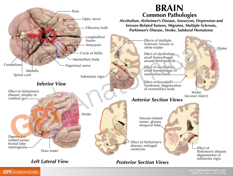 Diseased Brain in Skull Model