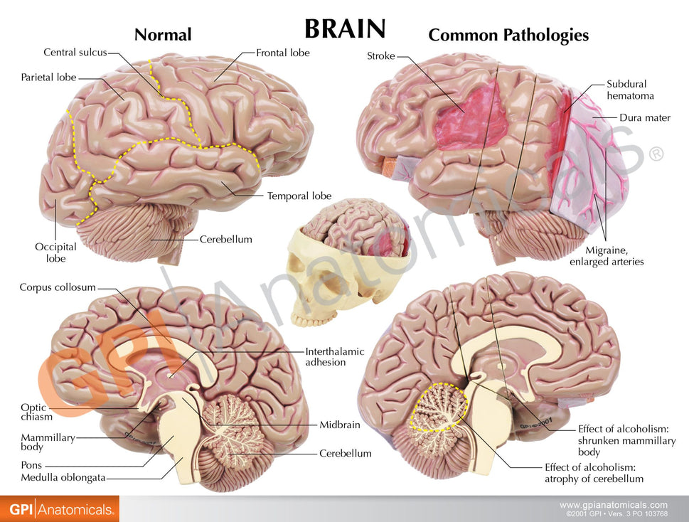 Diseased Brain in Skull Model