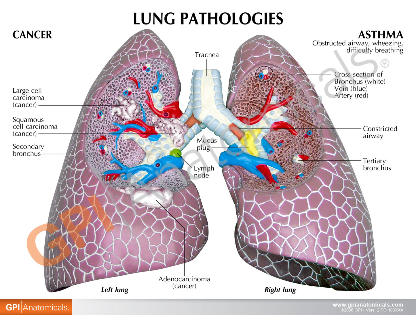 Diseased Lungs Model 3110 card back