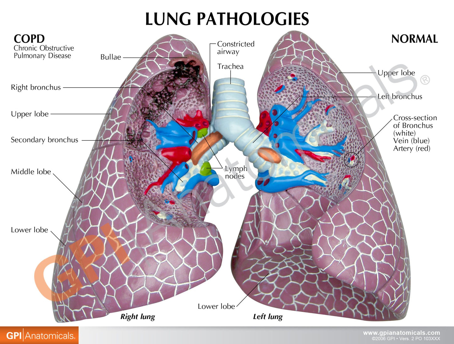 Diseased Lungs Model 3110 card front