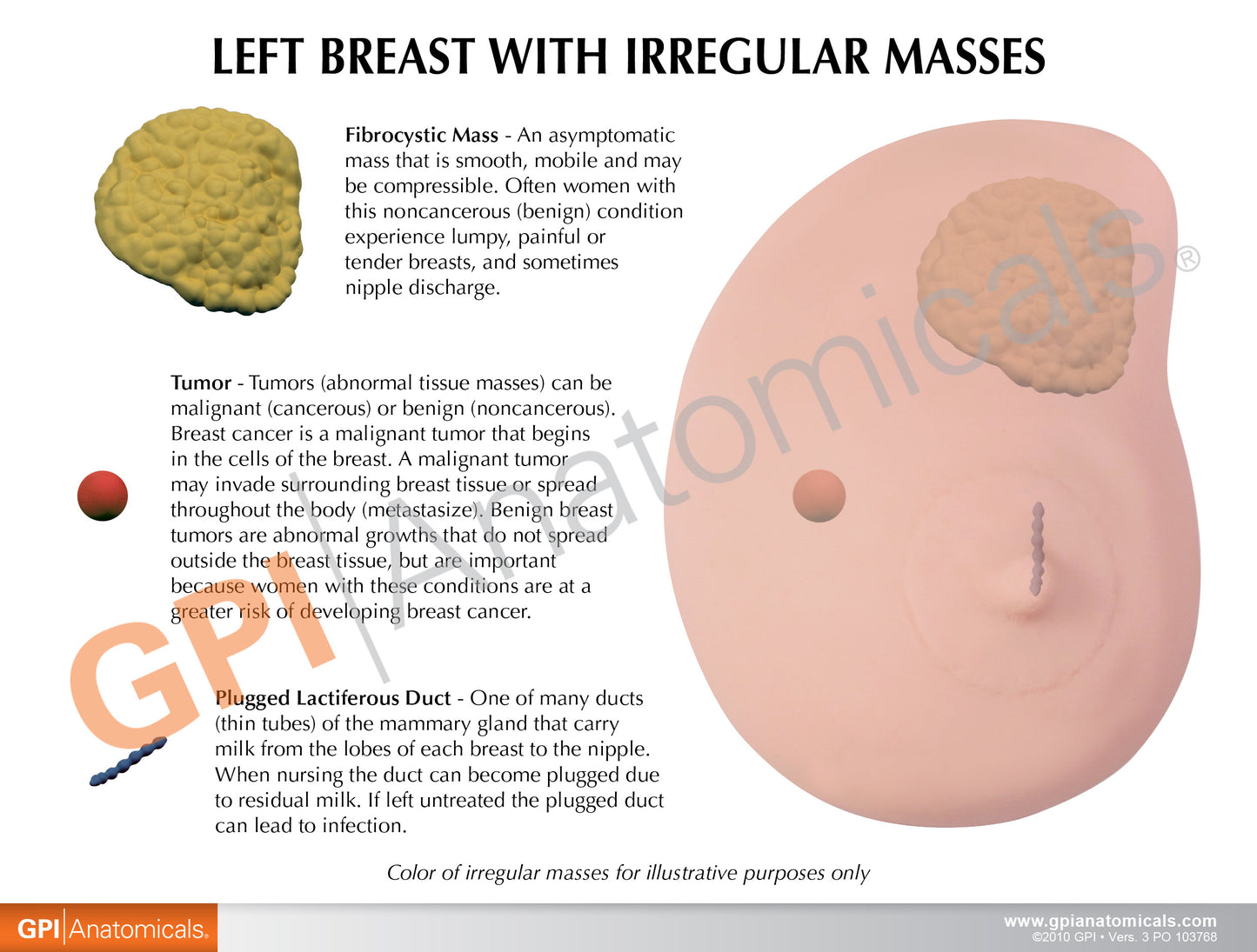 Breast cancer anatomical model includes a removable patient education card