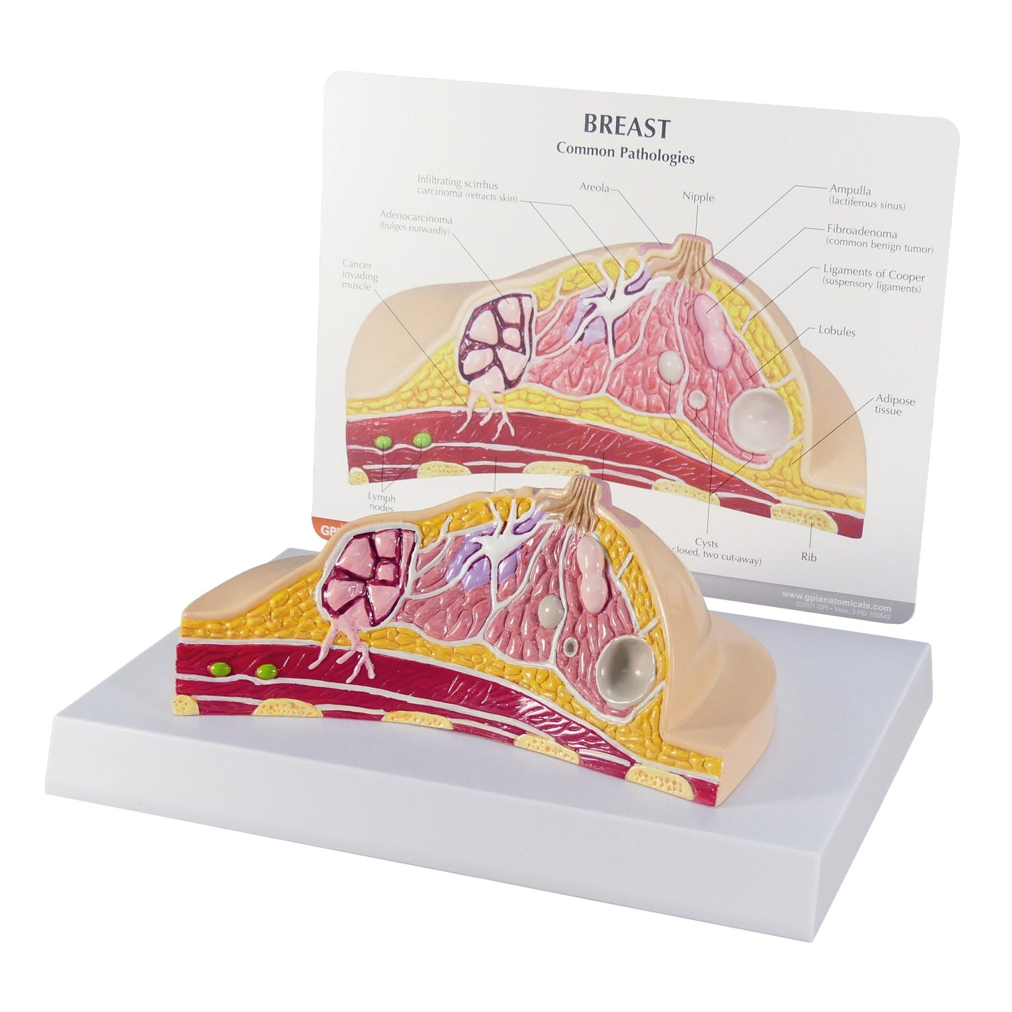 Breast Pathologies Anatomical Model 3450 model
