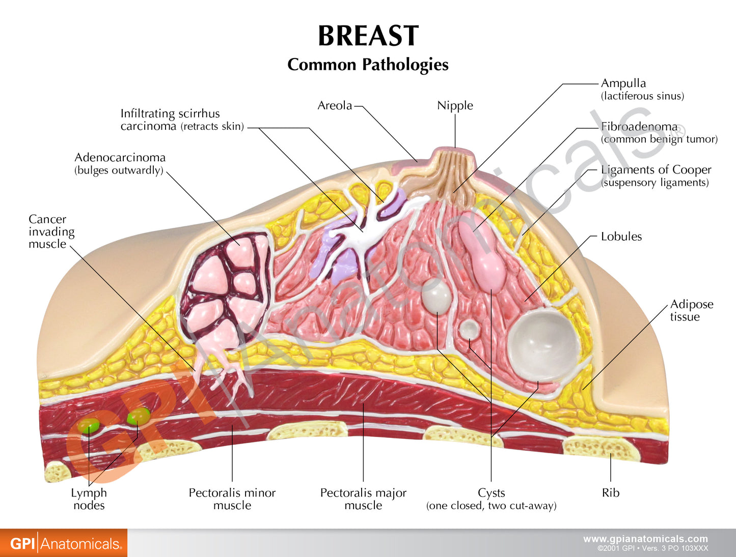 Breast Pathologies Anatomical Model 3450 card