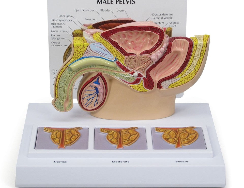 Male Pelvis Section Model with Enlarged Prostates