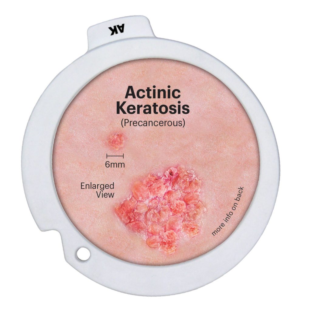 Precancerous and Cancerous Skin Lesions Disk Set