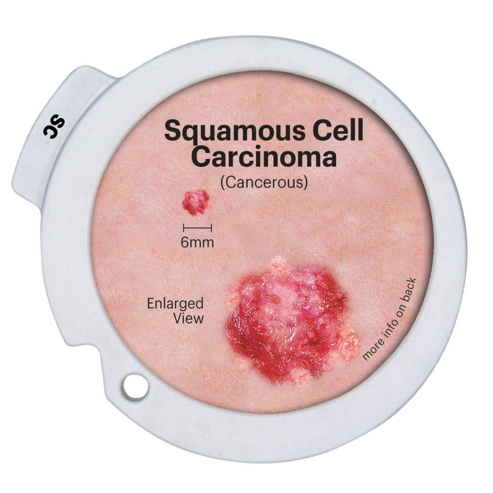 Precancerous and Cancerous Skin Lesions Disk Set