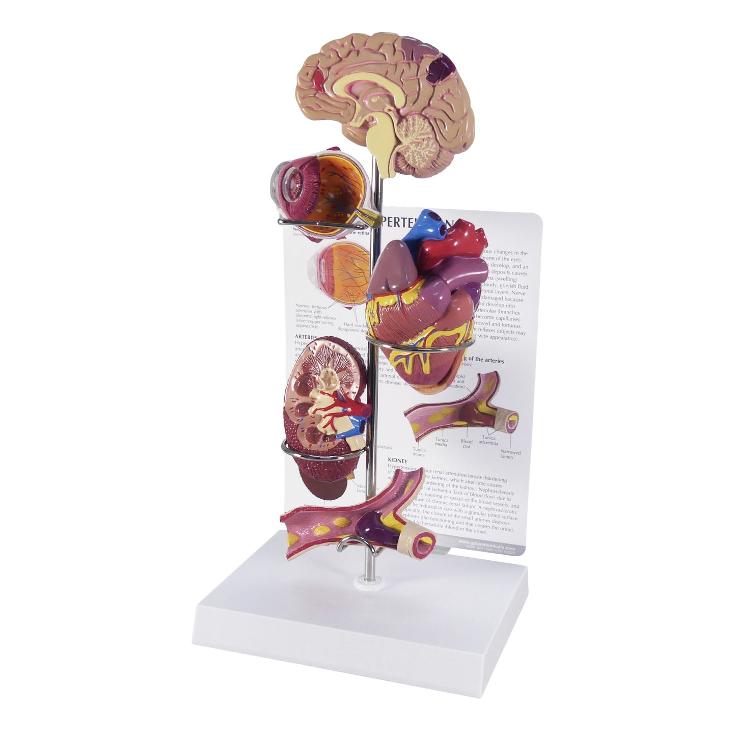Hypertension Model Set 4000 with card