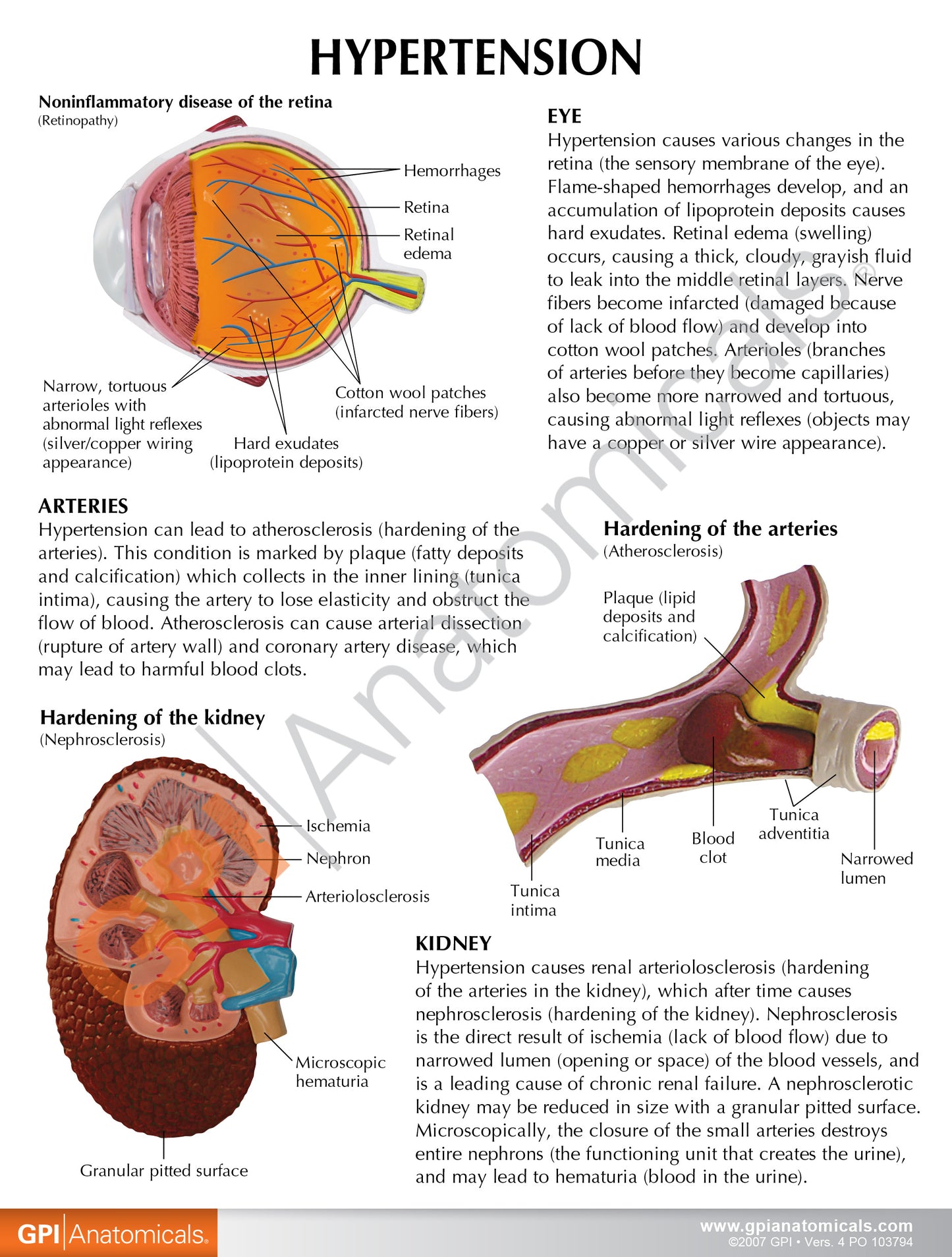 Hypertension Model Set 4000 card back