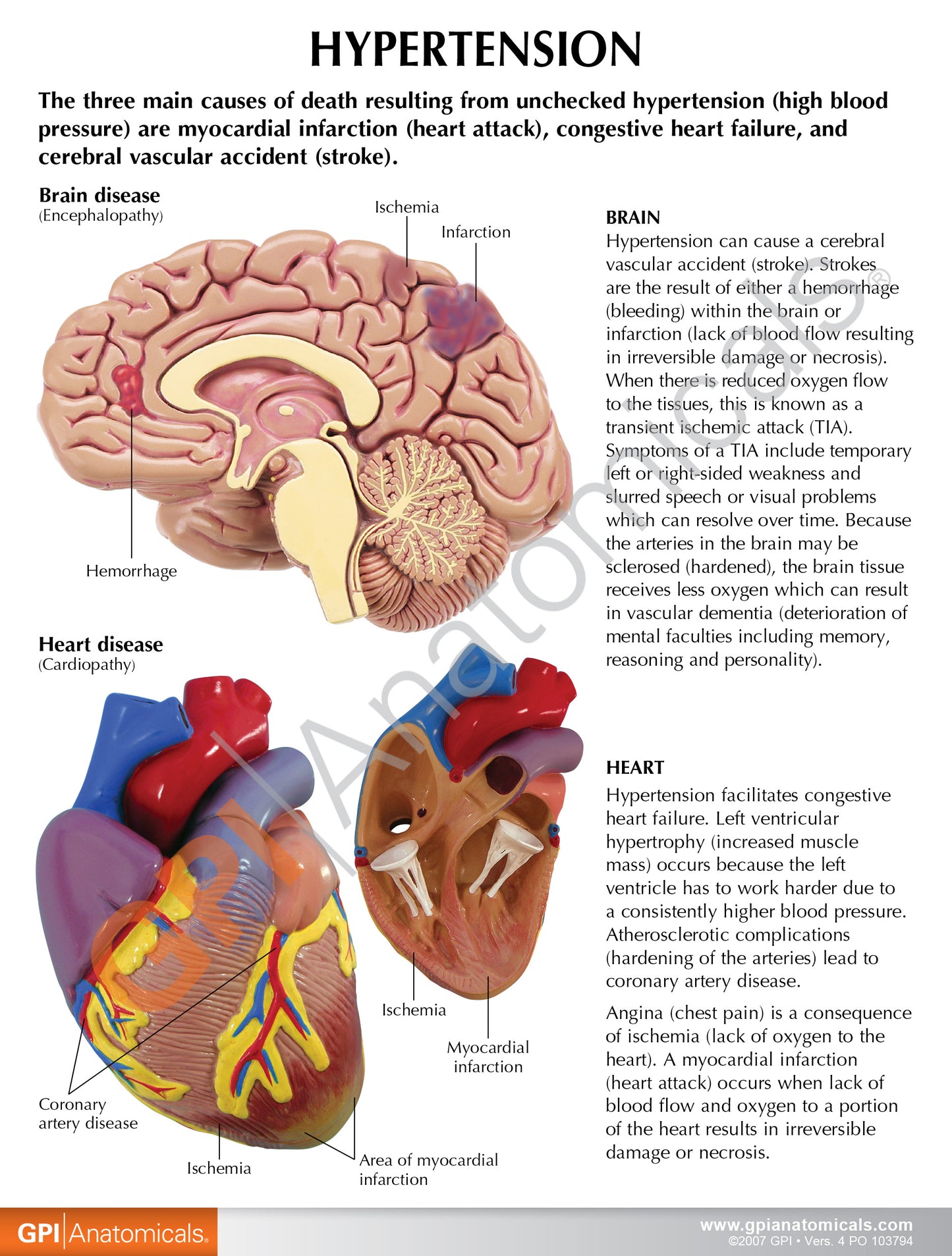 Hypertension Model Set 4000 card front