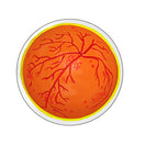 Switch Eye model shows diabetic retinopathy 3 image