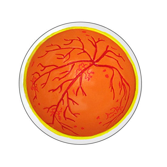 Eye model shows diabetic retinopathy