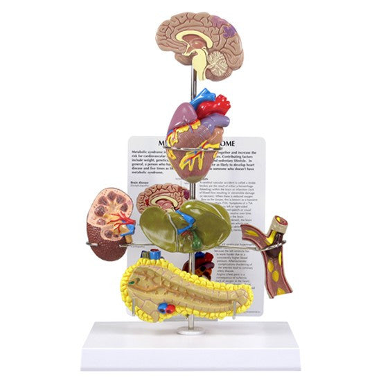 Metabolic Syndrome Model